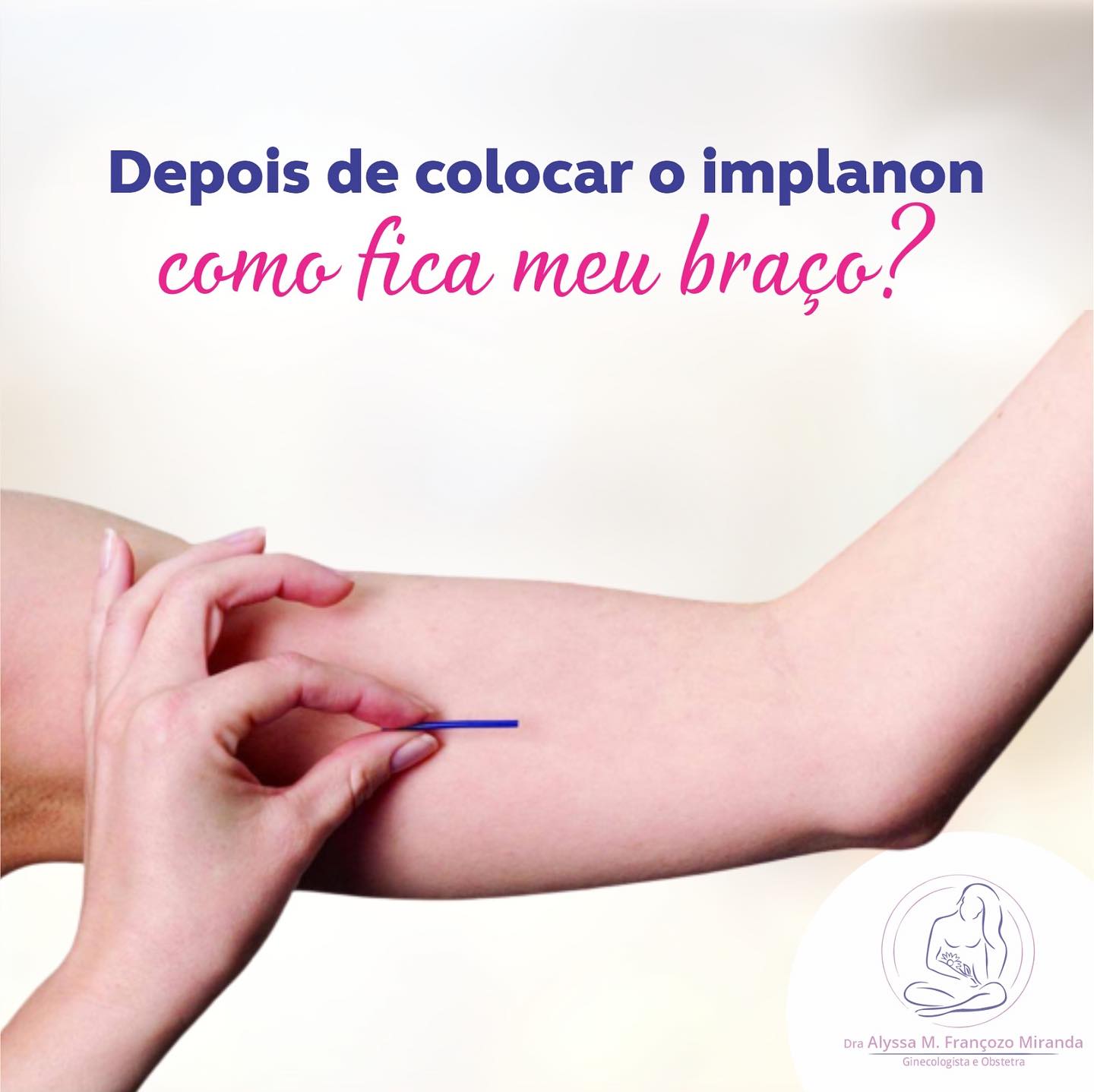 Como fica o braço após a colocação do implanon